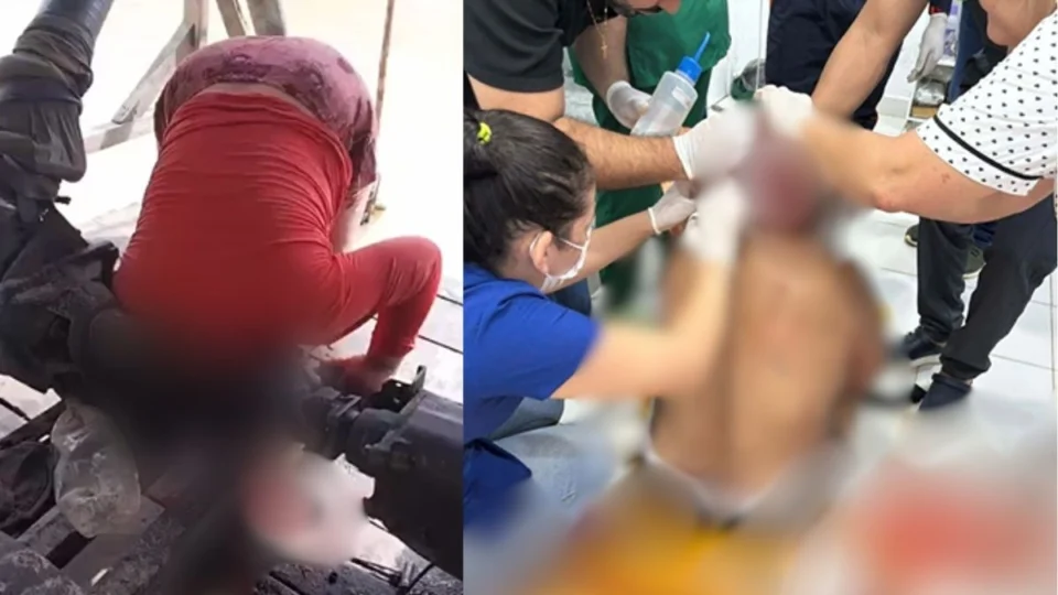 Jovem tem couro cabeludo arrancado ao prender cabelo em máquina no interior do Acre