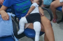 Acre firma convênio para criar banco de órteses e fortalecer tratamento do pé torto congênito