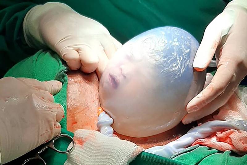 Parto raro no Pará Materno-Infantil de Barcarena realiza parto gemelar raro com bebê empelicado - Foto: Divulgação