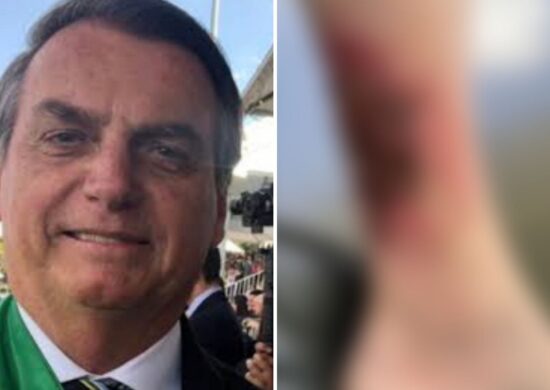 Bolsonaro se recupera de ferimento na perna