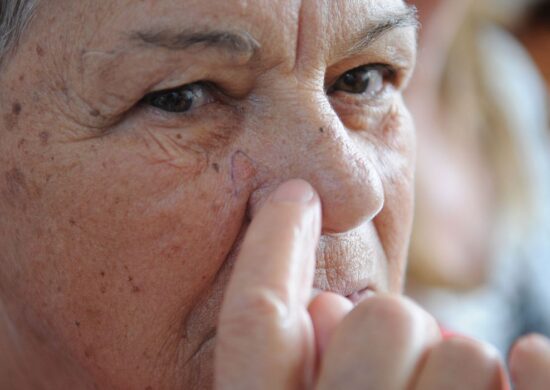 Câncer de pele pode ser prevenido com rotina de cuidados diários e acompanhamento profissional - Foto: Fábio Rodrigues Pozzebom/Agência Brasil