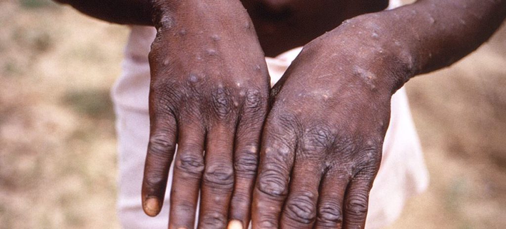 Mpox: Um jovem mostra as mãos durante um surto de varíola dos macacos - Foto: ONU/ CDC