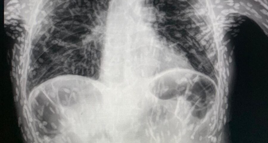 Parasitos Intestinais Verme-médico-divulga-raio-x-de-paciente-com-tórax-cheio-de-ovos-de-tênia-foto-reproducao-twitter-vitorborin_