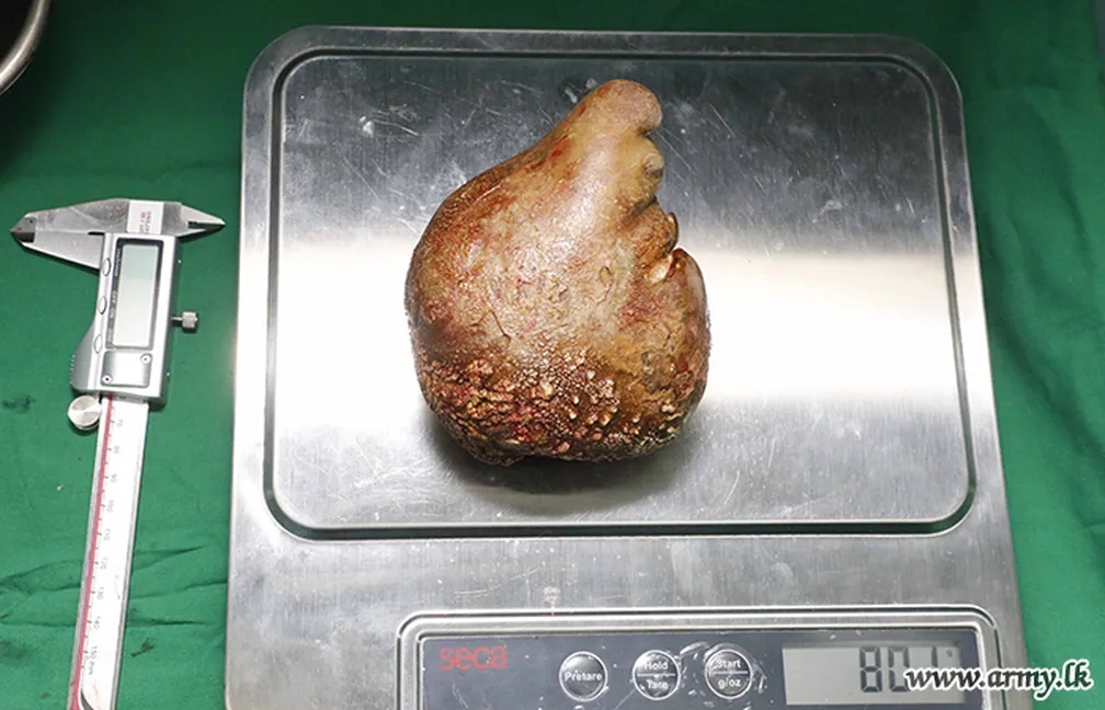 Pedra no rim pesava mais de 800 gramas - Foto: Divulgação-Exército Sri Lanka
