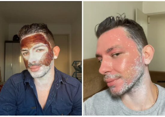 peeling de fenol-resultado-foto-reproducao-tiktok-joaoocastros