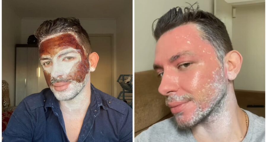 peeling de fenol-resultado-foto-reproducao-tiktok-joaoocastros