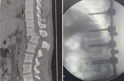 Após acidente em academia, homem teve coluna deslocada e corre risco de não andar mais - Foto: Reprodução/Arquivo Pessoal