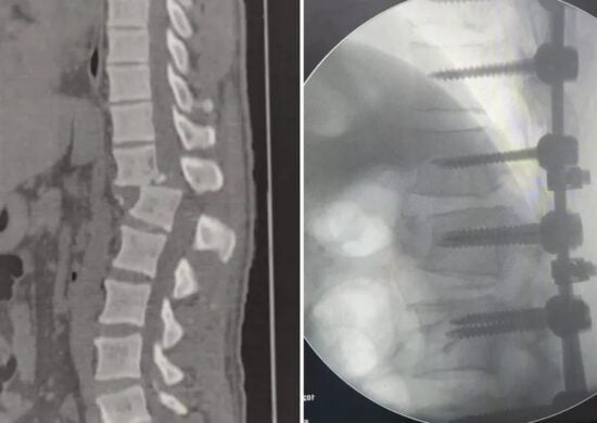 Após acidente em academia, homem teve coluna deslocada e corre risco de não andar mais - Foto: Reprodução/Arquivo Pessoal