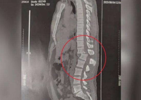 Após acidente em academia, homem teve coluna deslocada e corre risco de não andar mais - Foto: Reprodução/Arquivo Pessoal