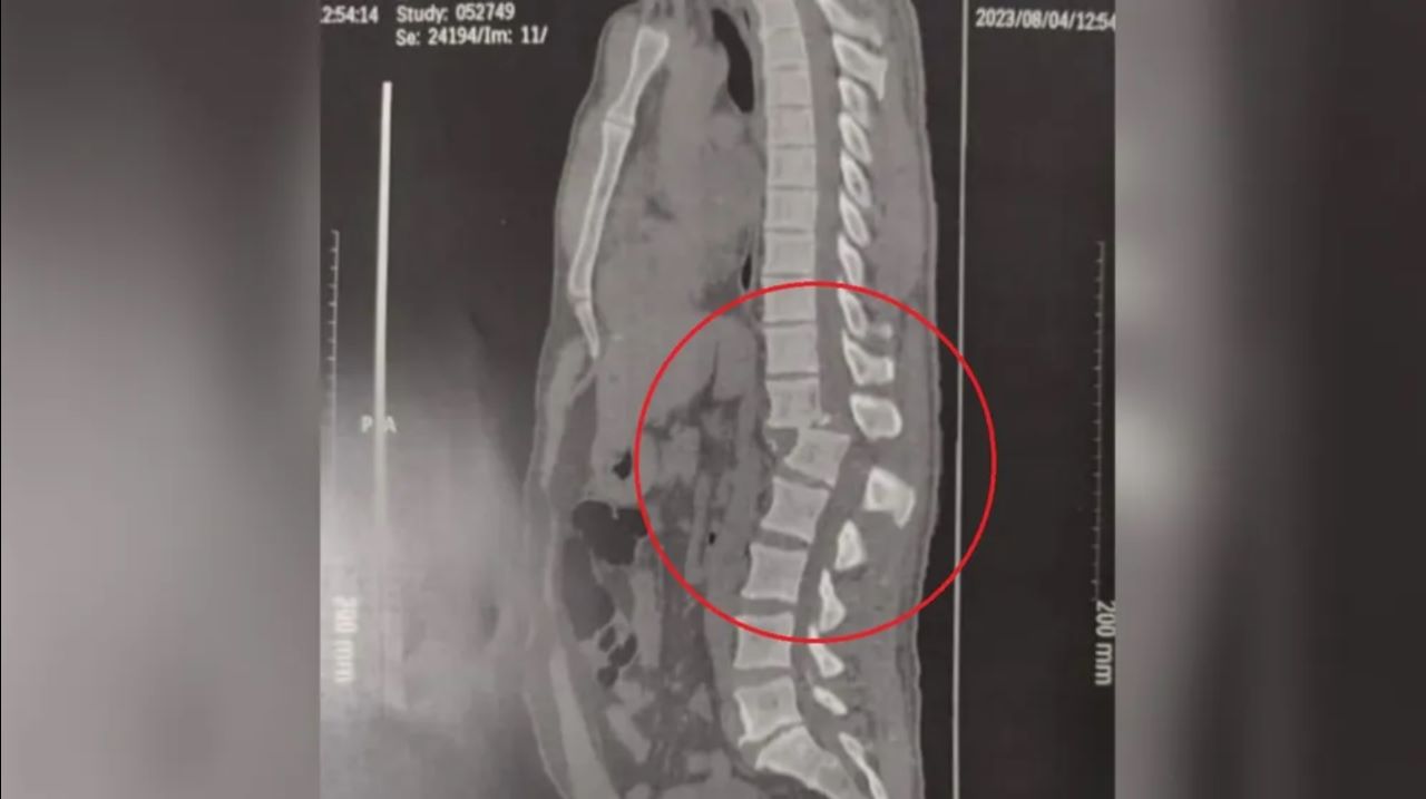Após acidente em academia, homem teve coluna deslocada e corre risco de não andar mais - Foto: Reprodução/Arquivo Pessoal