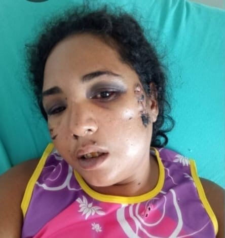 Vítima de tiro na cabeça pelo marido faz campanha para custear cirurgia