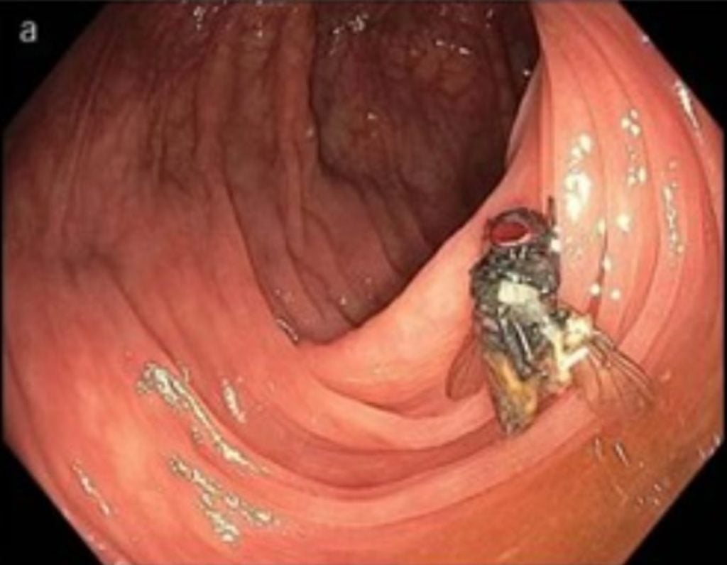 Paciente de 63 anos faz exame e descobre mosca intacta no intestino