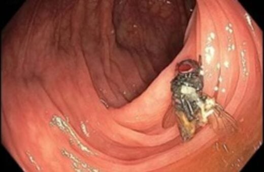 Paciente de 63 anos faz exame e descobre mosca intacta no intestino