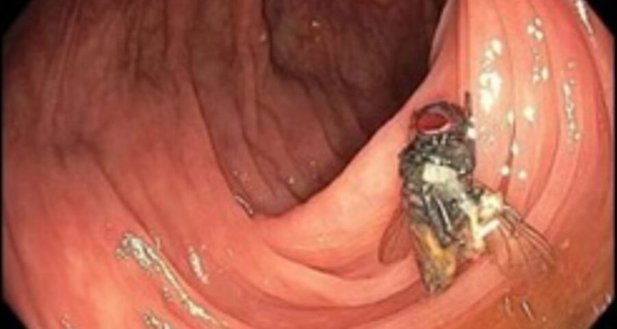 Paciente de 63 anos faz exame e descobre mosca intacta no intestino