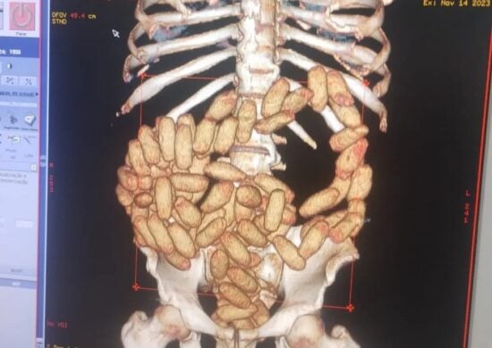 raio-x-capsulas-cocaina-estomago-passageiros-sp-foto-divulgacao2