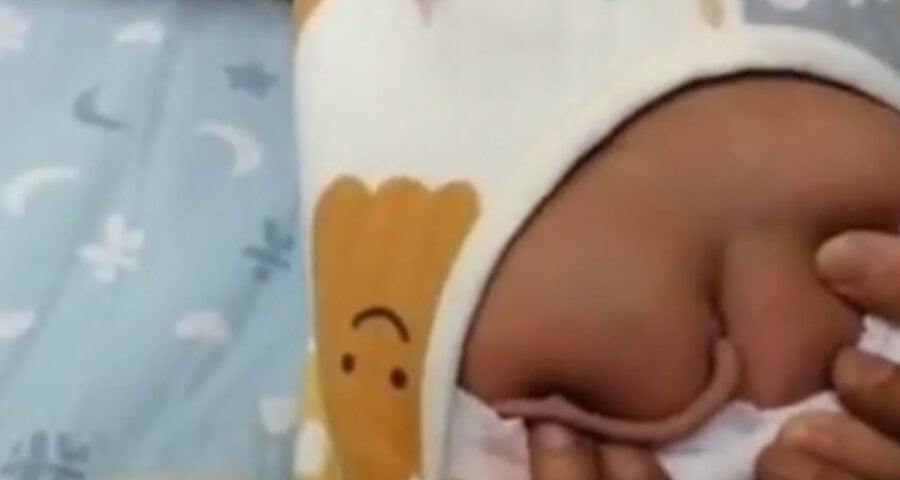 Bebê recém-nascido nasce com cauda de 10 cm na China