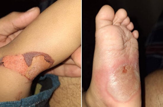 Bebê é torturado com queimaduras pelo corpo em Manaus