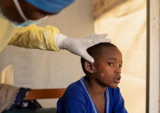 Mpox é emergência sanitária global. Foto: Arlette BashiziReuters